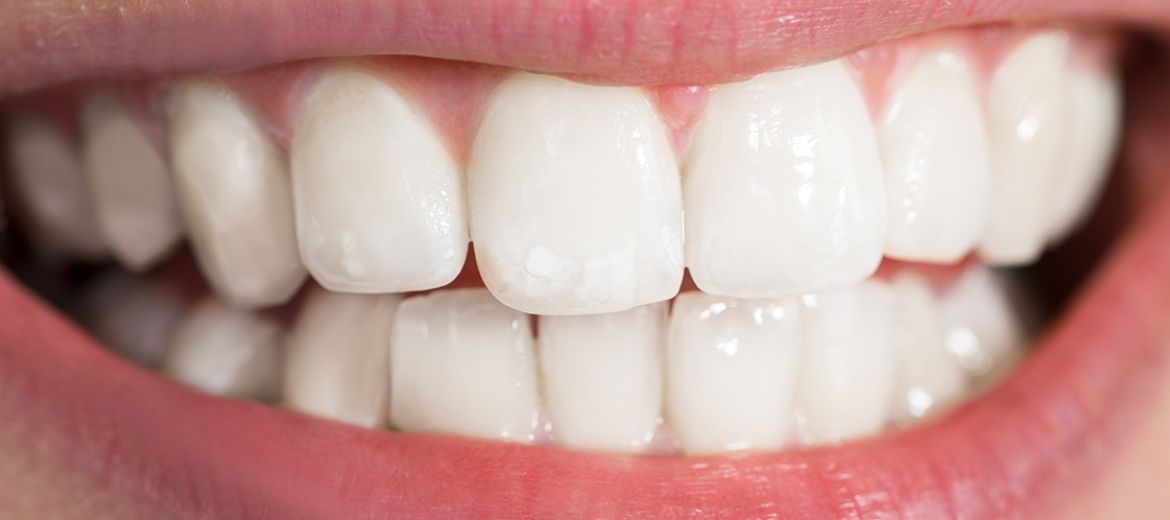 White Fillings